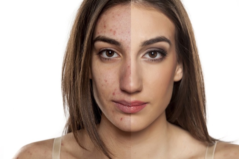 Cicatrici Segni Macchie Da Acne Ecco Come Eliminarli