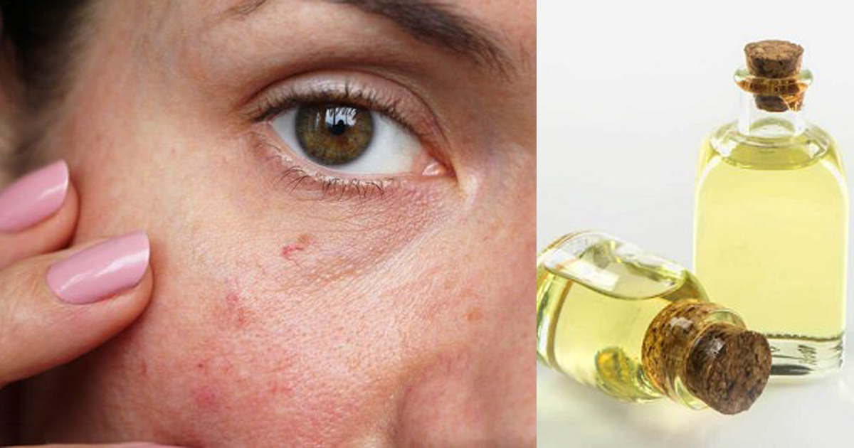 How To Use Castor Oil for Spider Veins on the Face Cradiori