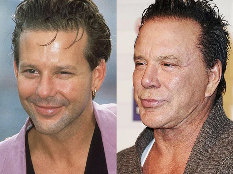 Mickey Rourke's Face Is Destroyed by Too Many Botched Plastic Surgeries