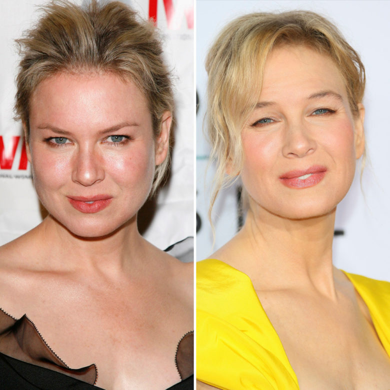 Renée Zellweger Turns 51 How Plastic Surgery Changed Her Look Over the