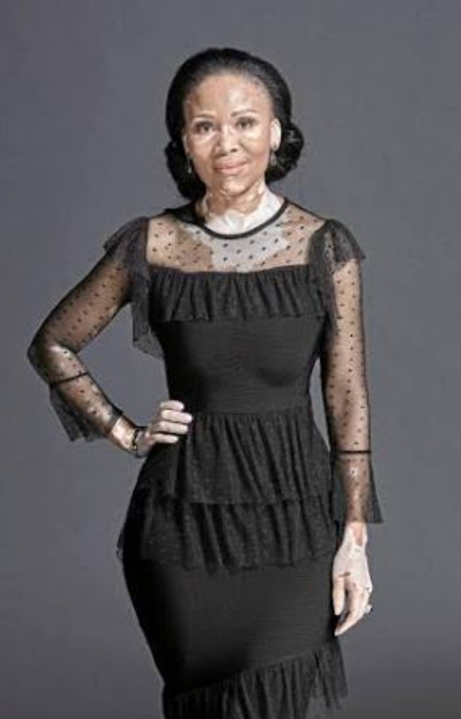 Leleti "Sarafina" Khumalo on educating people about vitiligo eaglemedia.co.za