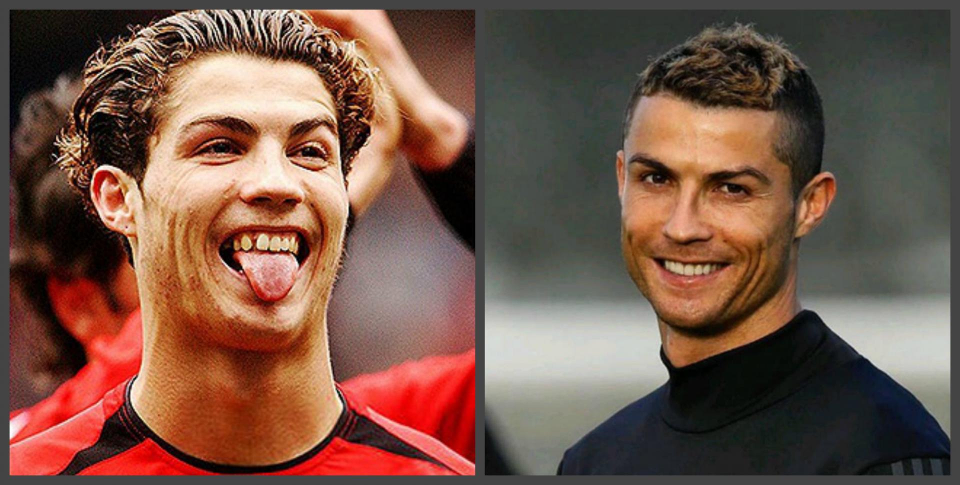 Cristiano Ronaldo teeth before and after, a selection of photos