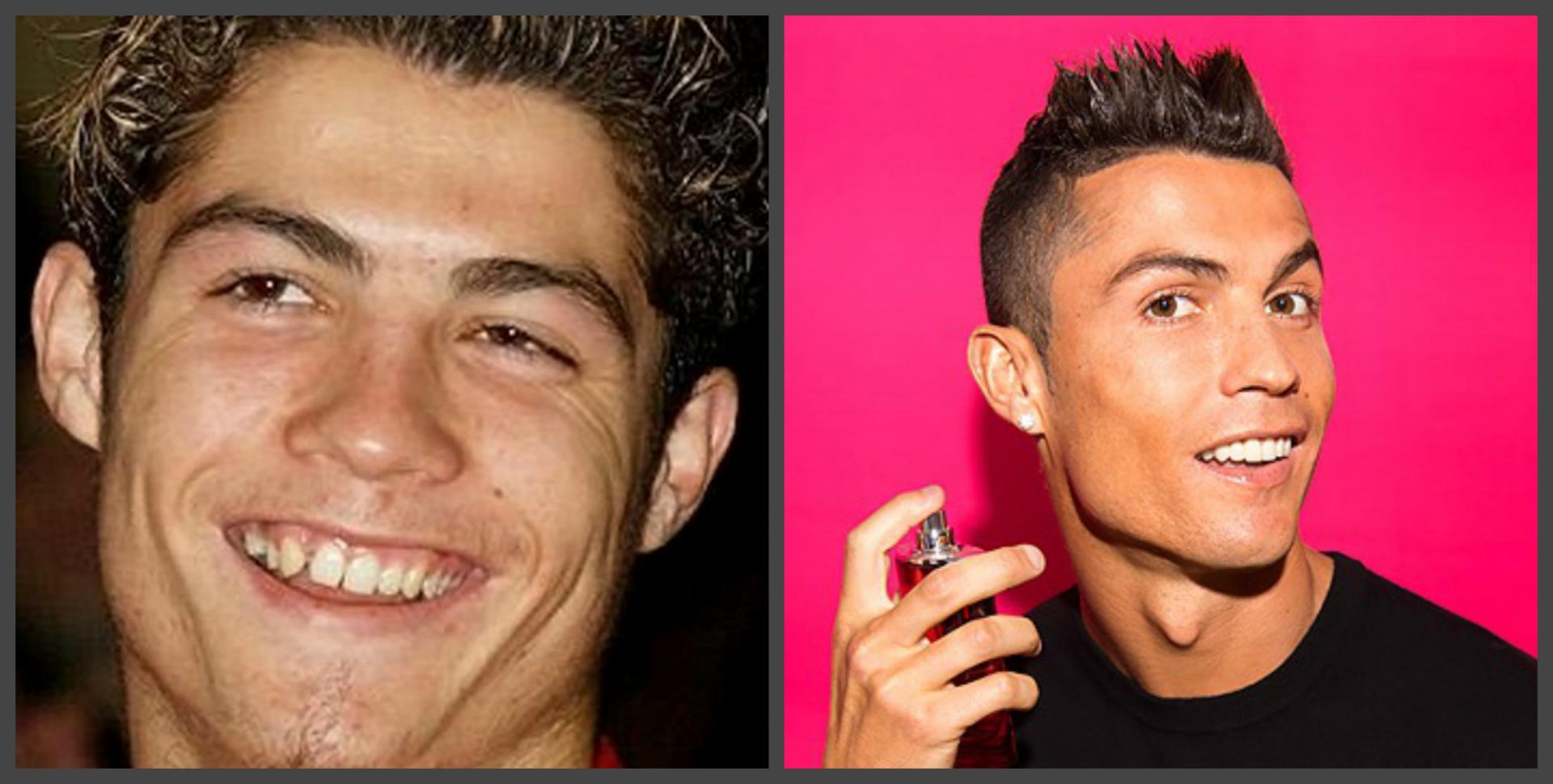 Cristiano Ronaldo teeth before and after, a selection of photos