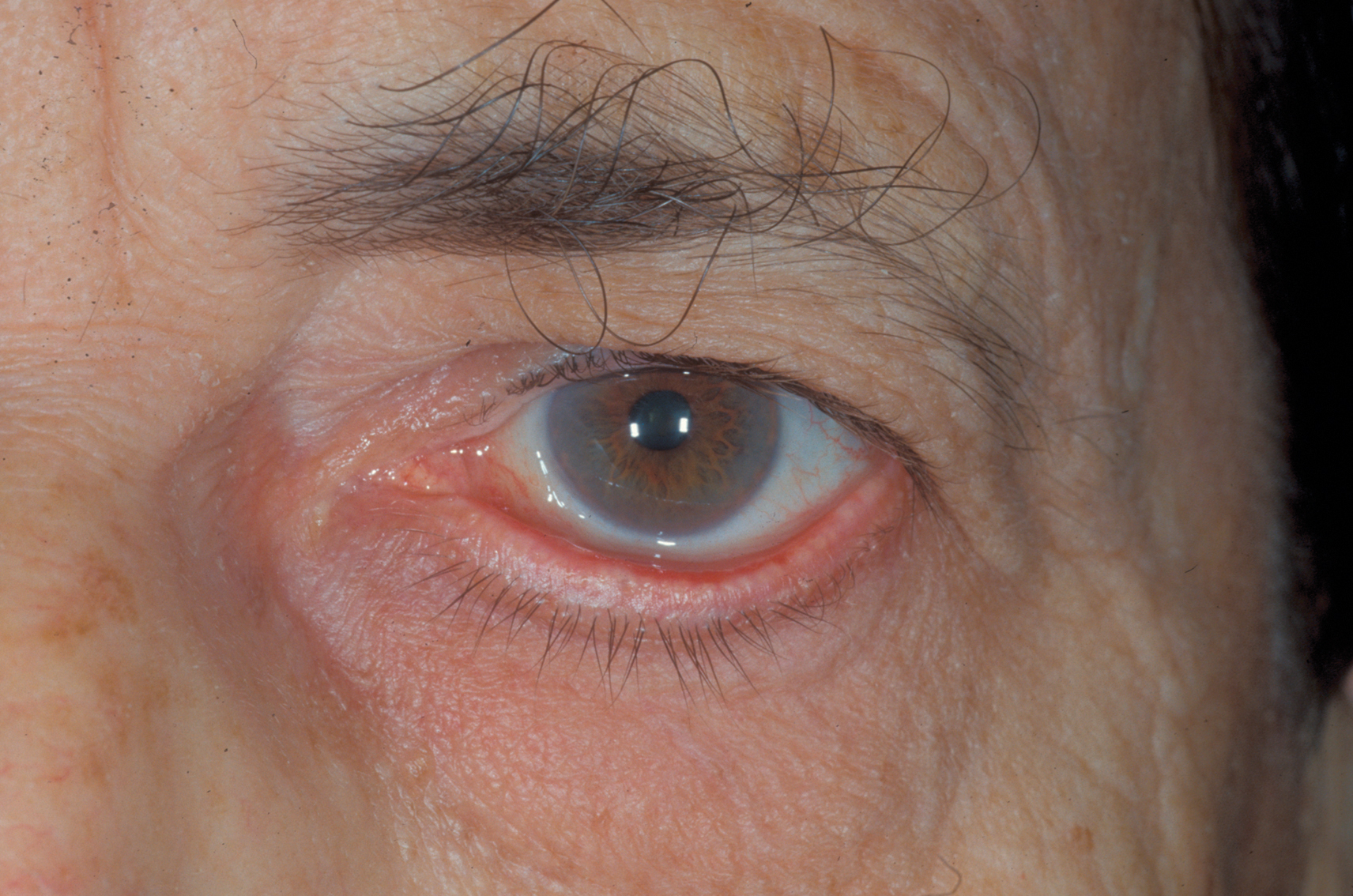 Diagnosis And Treatment Of Ectropion Ento Key