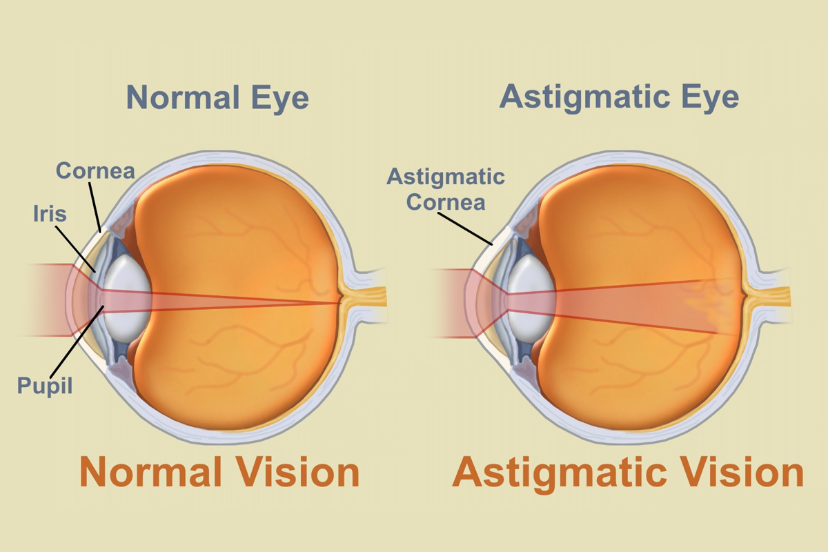 Astigmatism and Presbyopia Family Eyecare