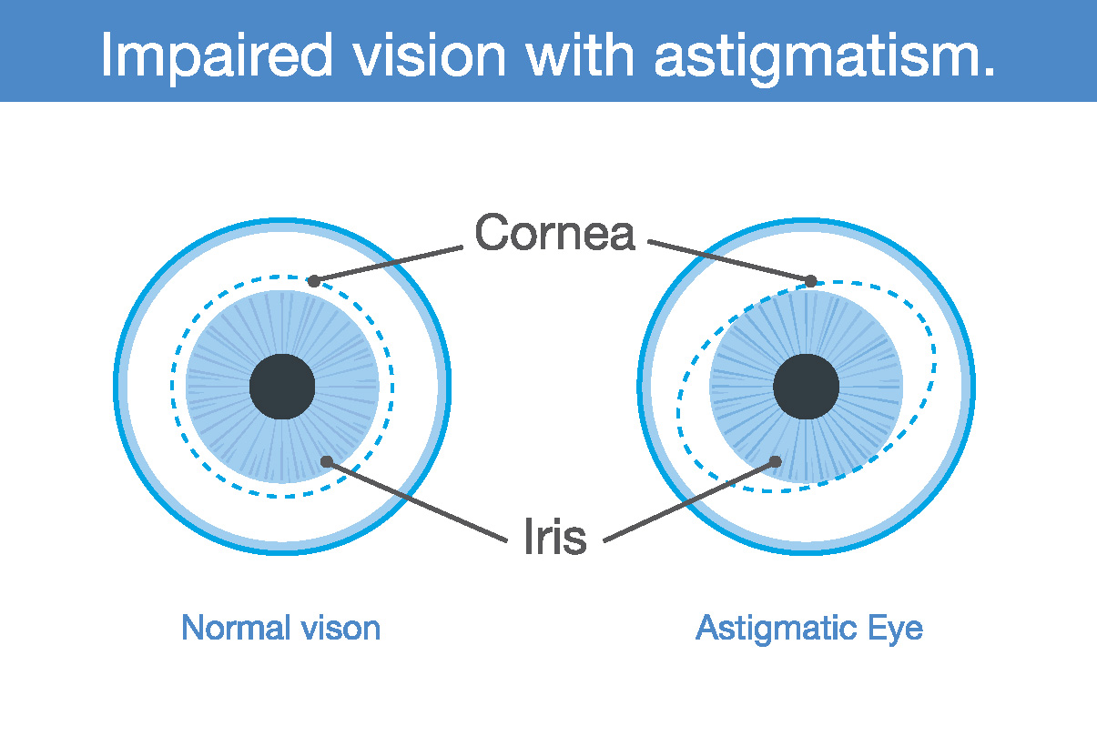 Astigmatism causes Blurred Vision First Eye Care Downtown Dallas