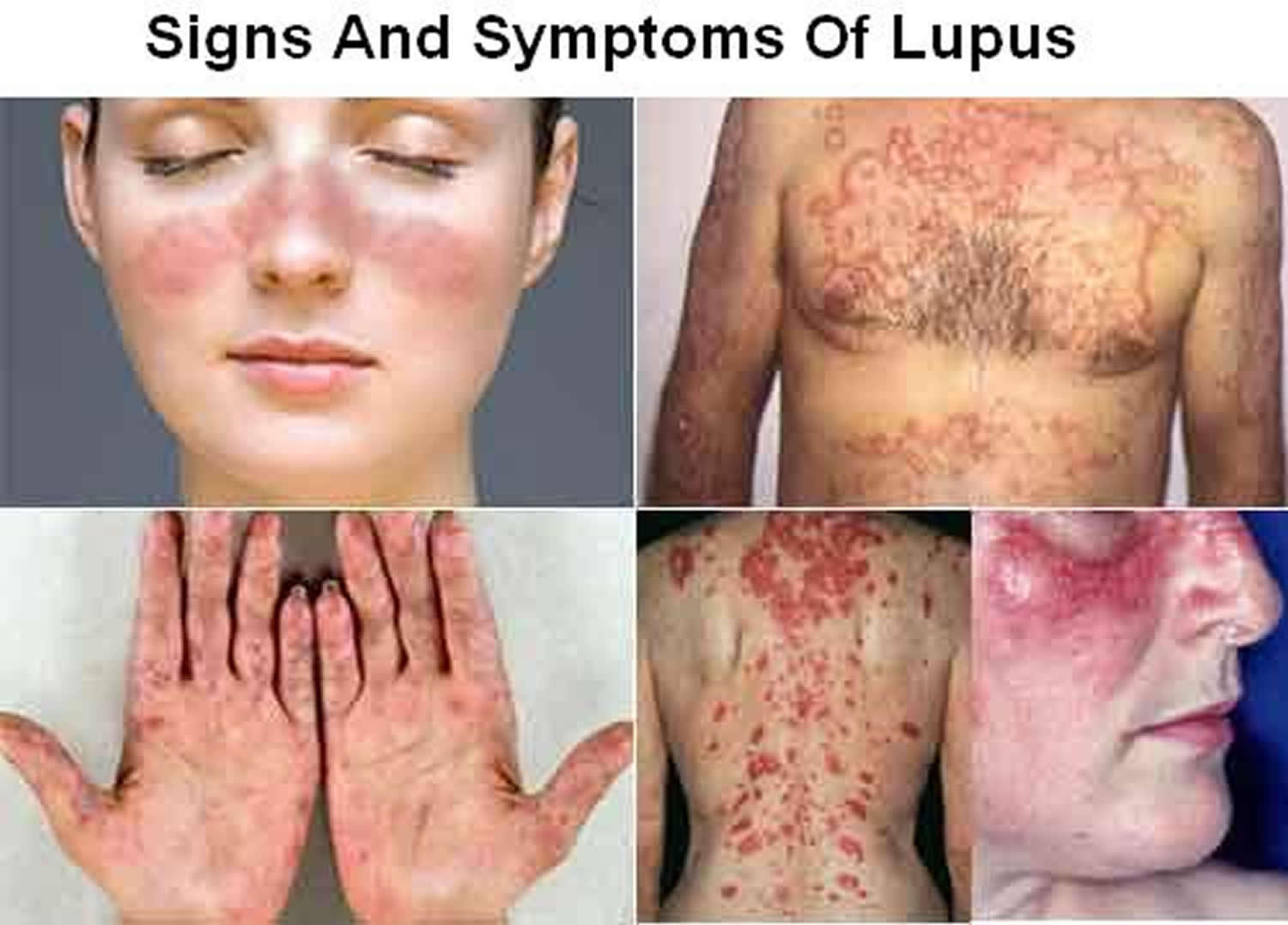 Lupus Systemic Lupus Erythematosus (SLE) Causes, Sign & Symptoms