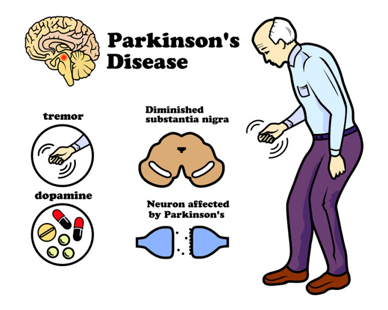 Parkinson's Disease Symptoms, Causes, Diagnosis & Treatment HealthPulls