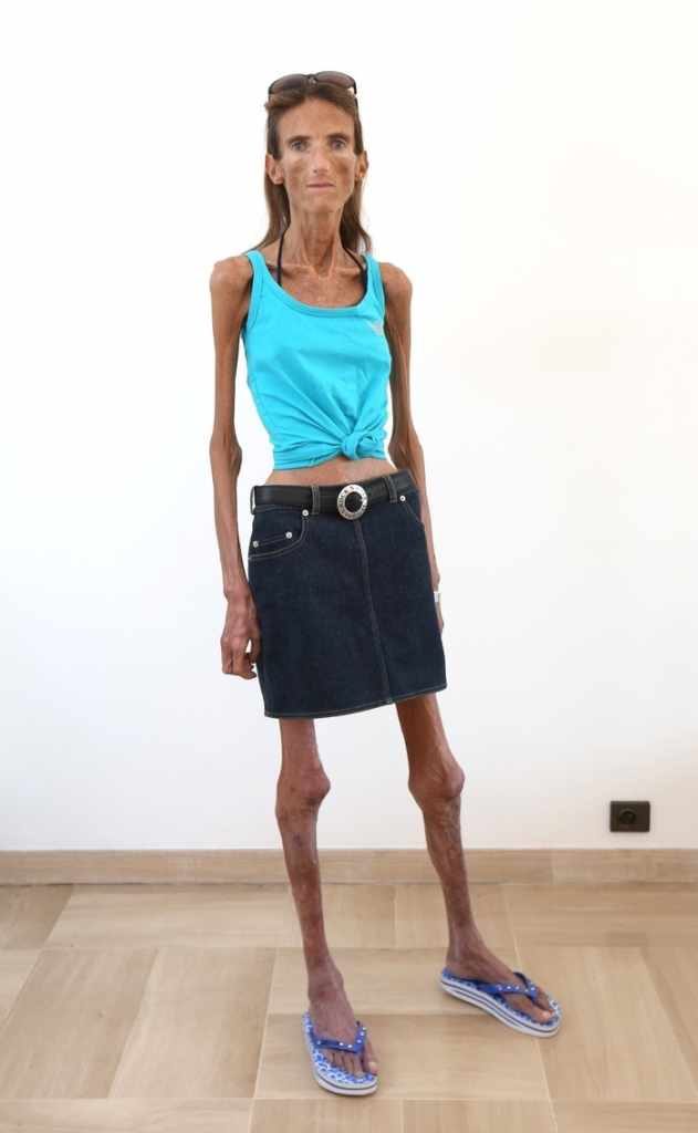 Who is the Skinniest Person in the World? It's a real shock