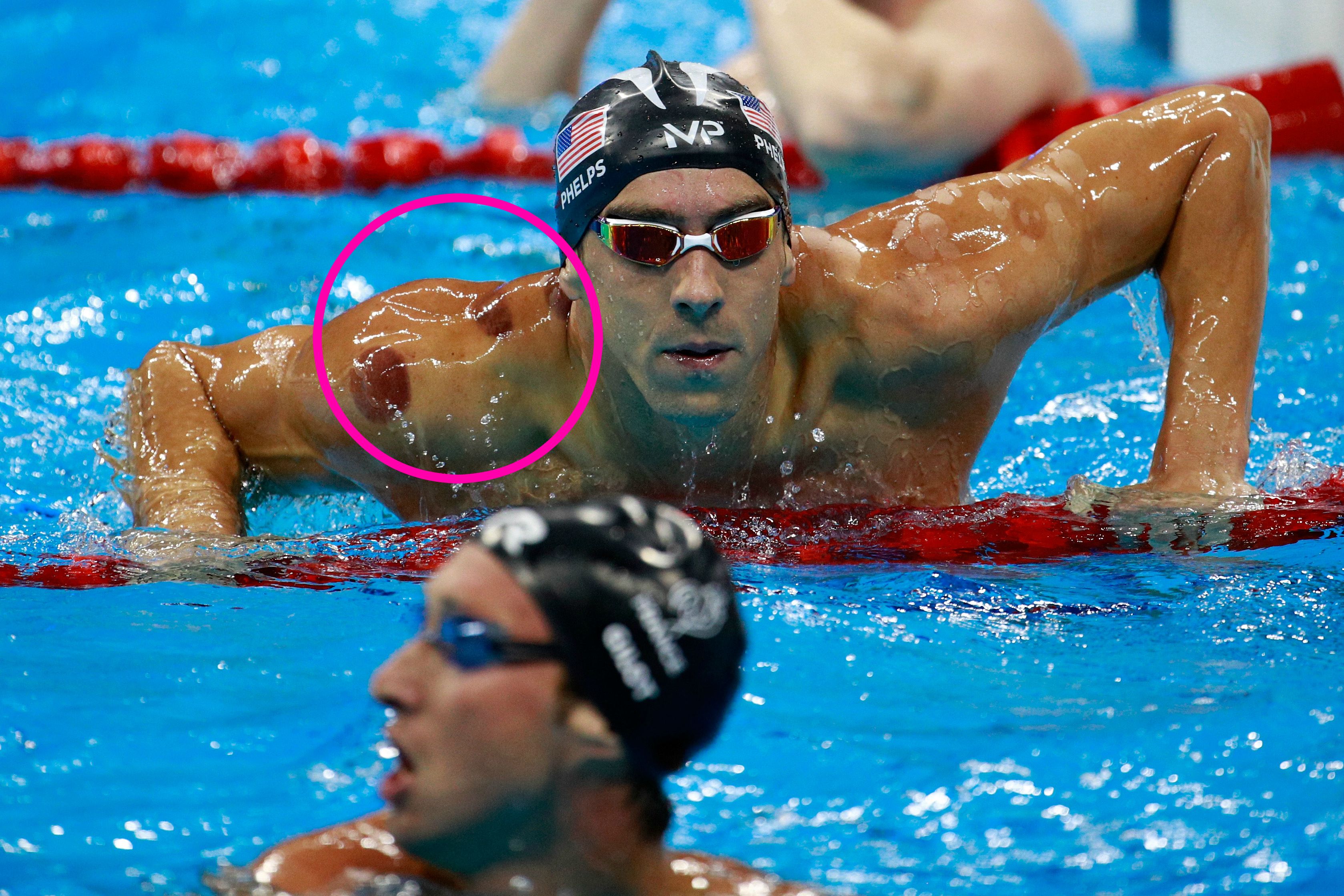 Spots on Michael Phelps What is Cupping