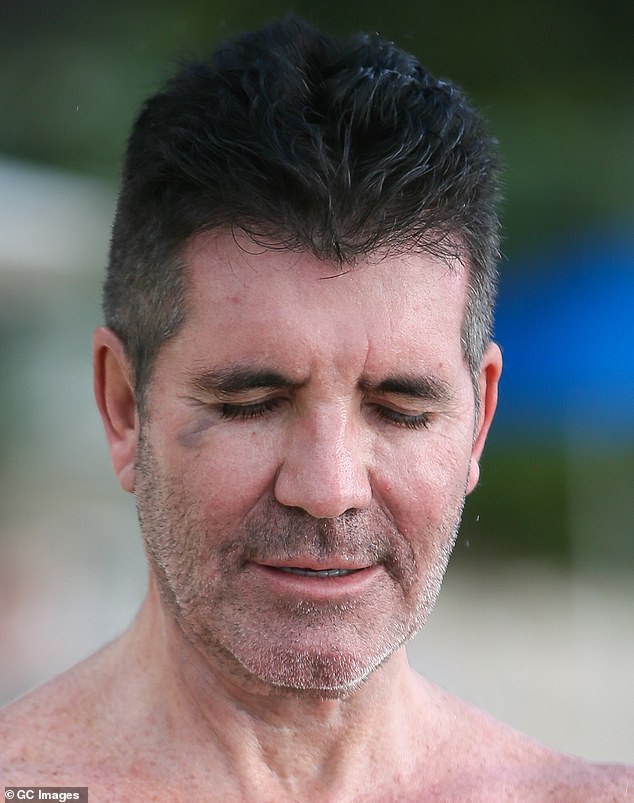 Simon Cowell sports a black eye after getting knocked in the face by his own