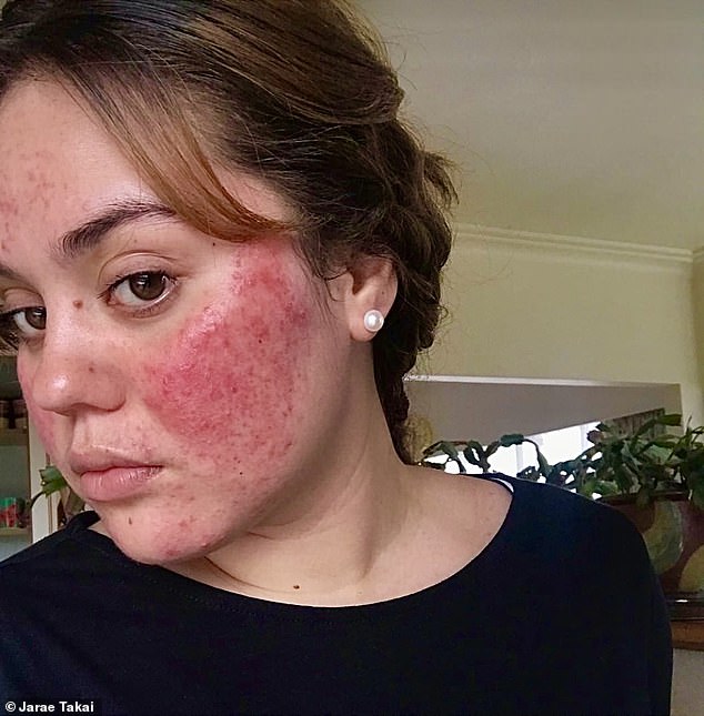 Rosacea sufferer claims a cream made from capers helped to improve her