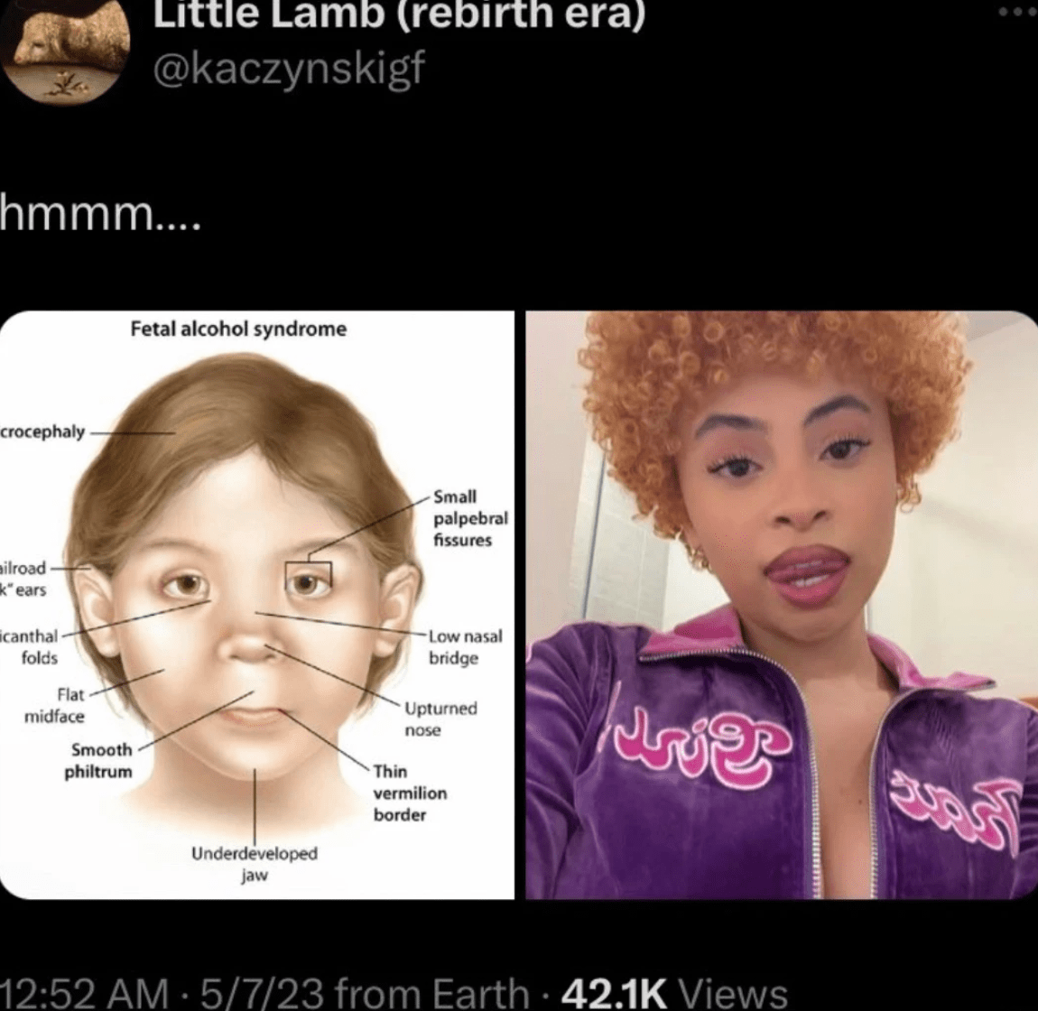 Ice Spice Fetal Alcohol Syndrome Ice Spice Down Syndrome Theory Know Your Meme