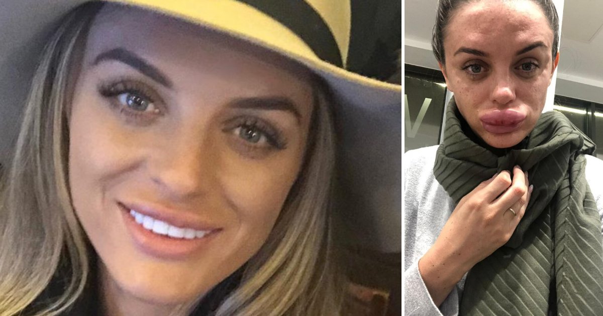 Botox Gone Wrong! Woman's Lips Left Swollen After Getting Fillers From