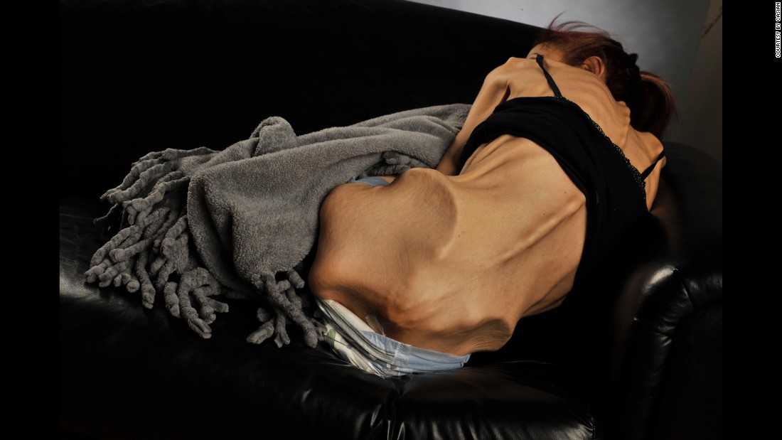 Woman battling anorexia gets help via online donations