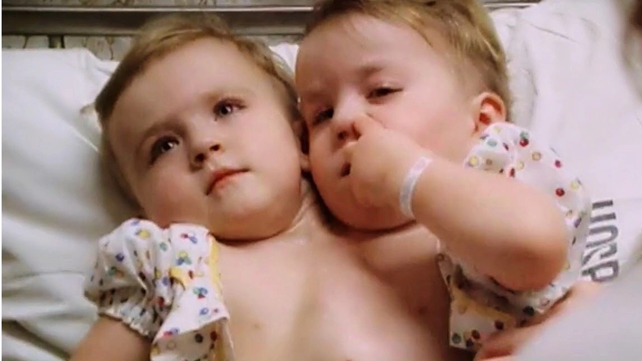 Katie and Eilish Siamese Twins (1992) MUBI