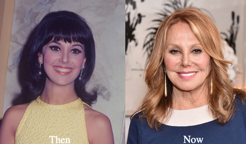 Marlo Thomas Plastic Surgery Before and After Photos Latest Plastic