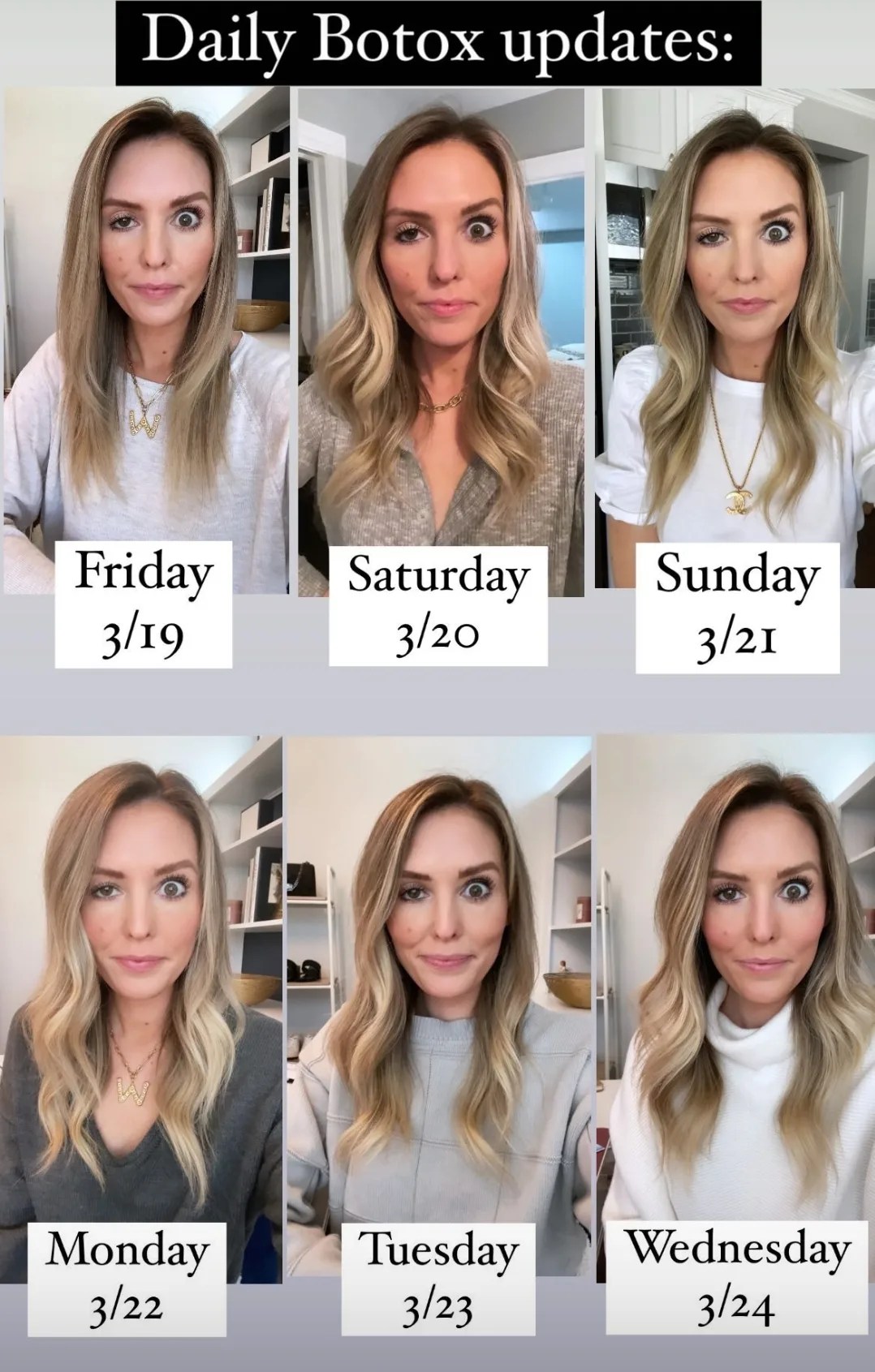 Influencer shares shocking results of when botox goes wrong Her.ie