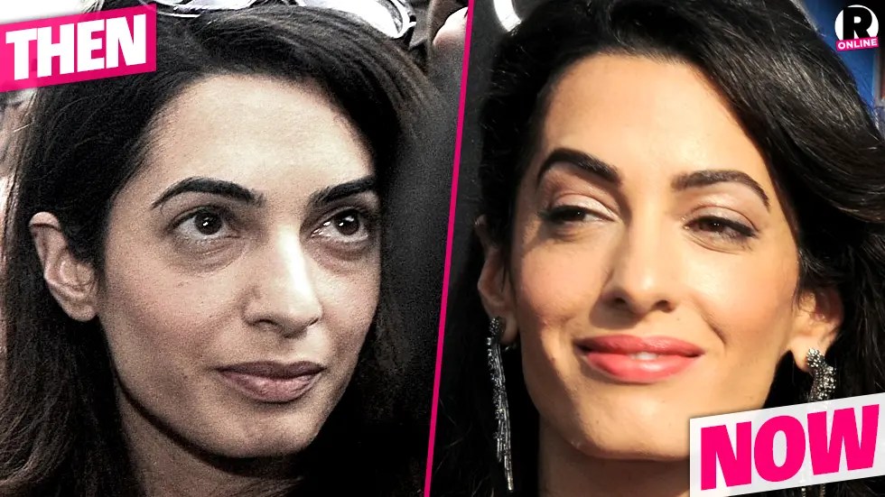 Plastic Is Perfect! Amal Clooney's Shocking New Face Is From Secret