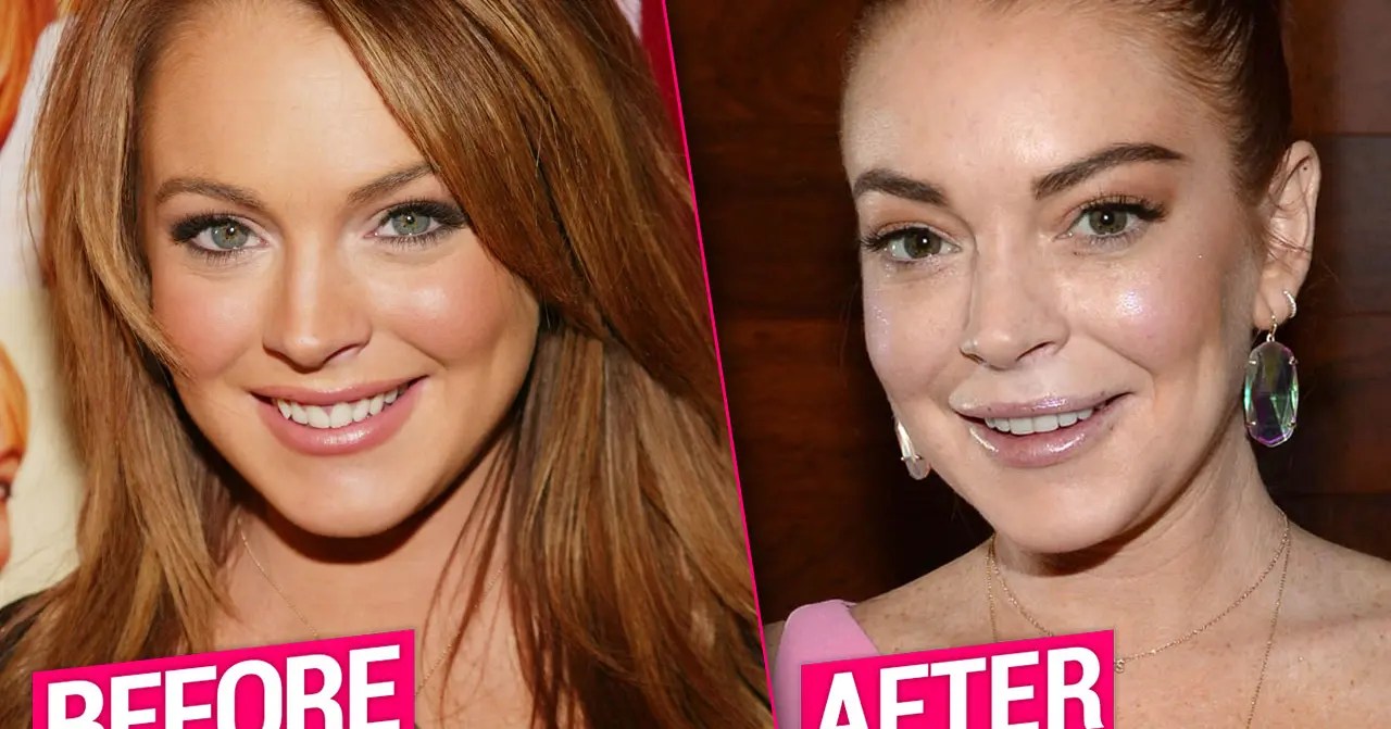 Lindsay Lohan's Plastic Surgery Makeover Exposed By Top Docs