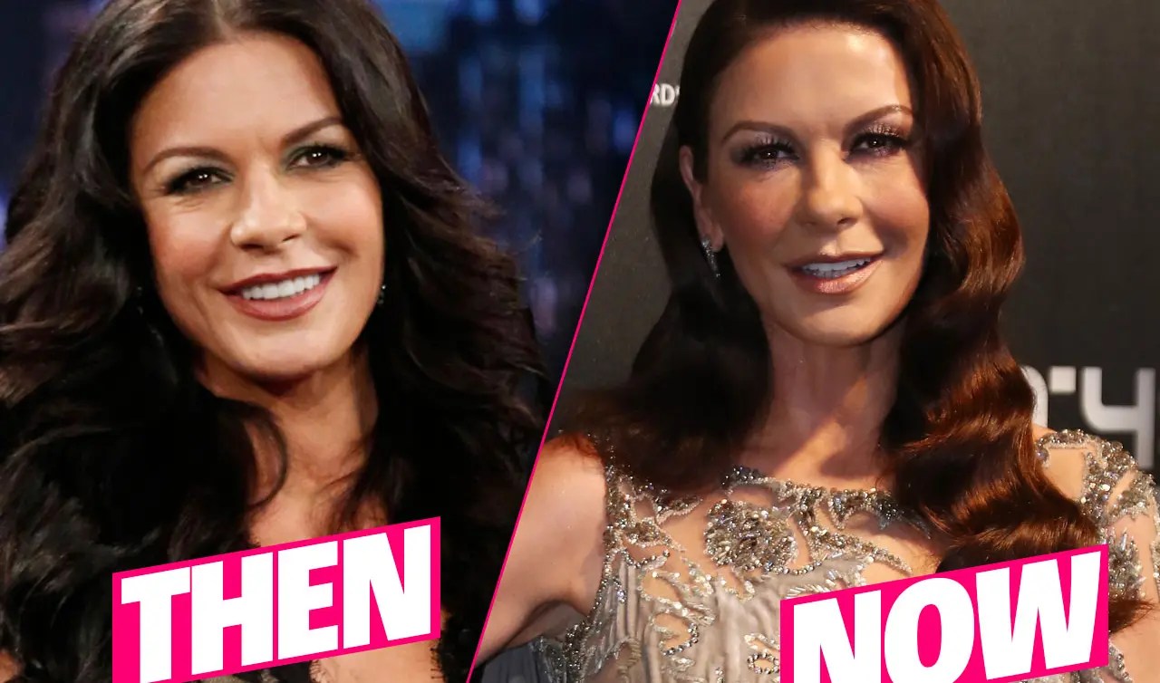 Catherine Zeta Jones Plastic Surgery Disaster Exposed By Top Docs