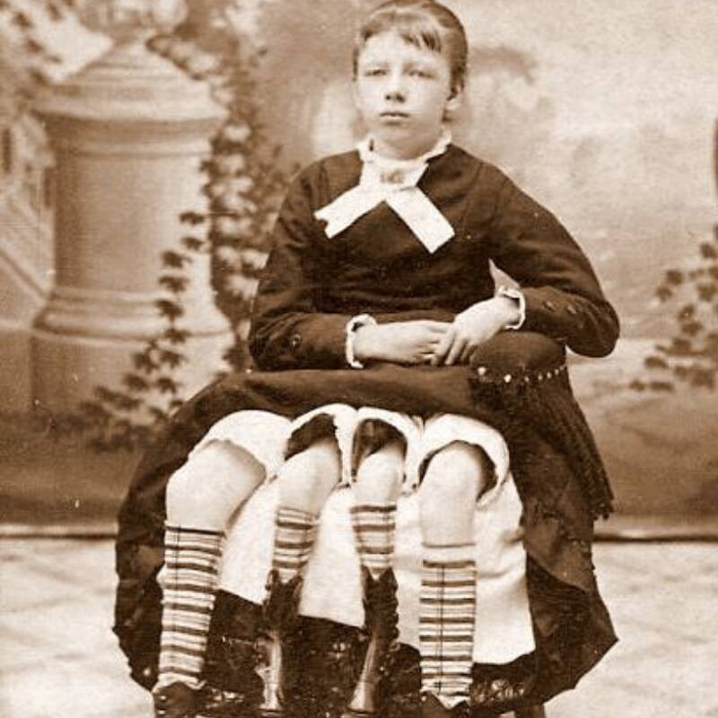 Josephine Myrtle Corbin, "the 4legged woman" her story, facts, and