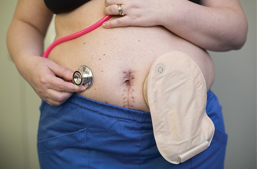 Morbo Di Crohn E Colite Ulcerosa La Giornata Mondiale Oggiscienza