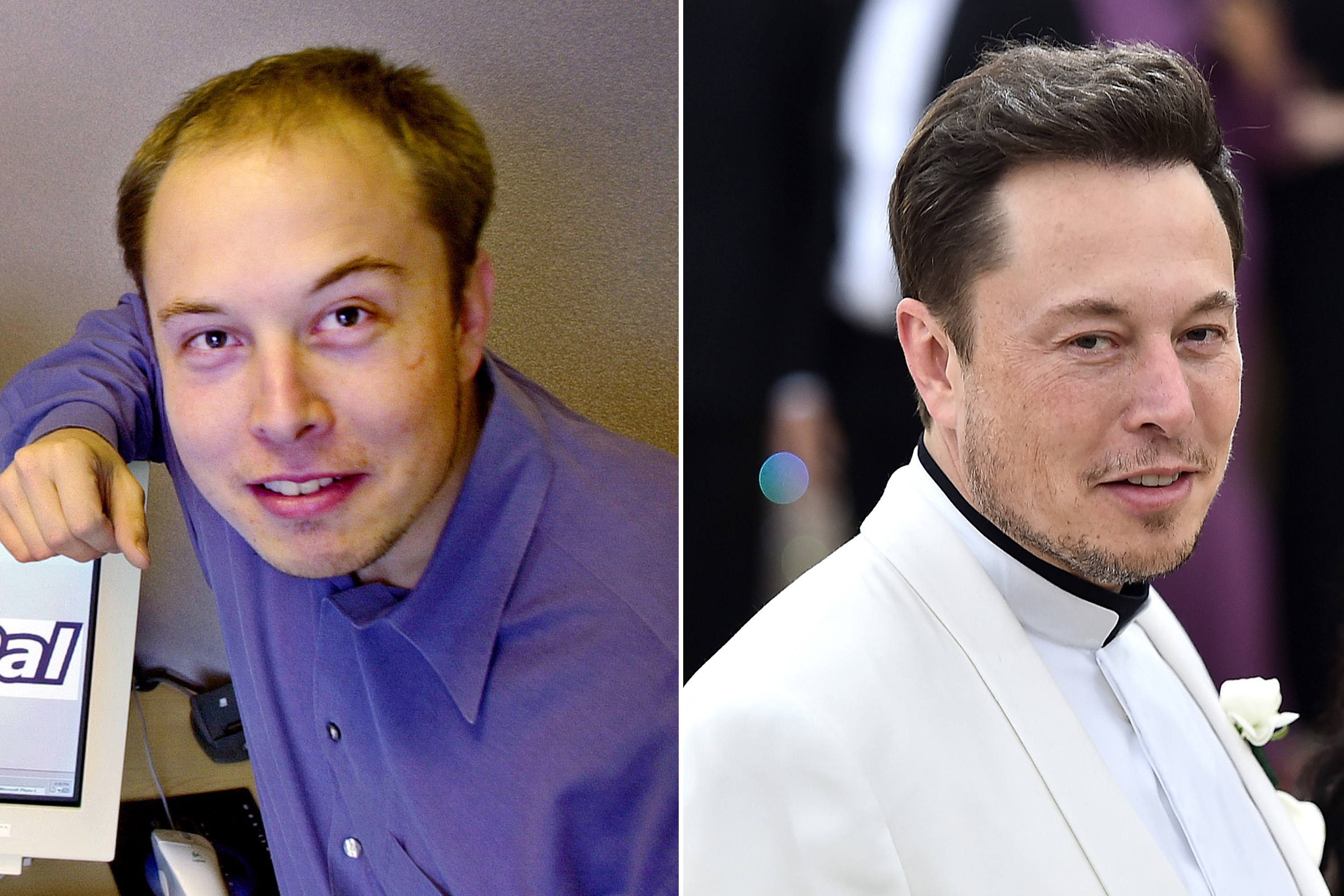 It's 'highly likely' Elon Musk spent over 20K on hair transplant