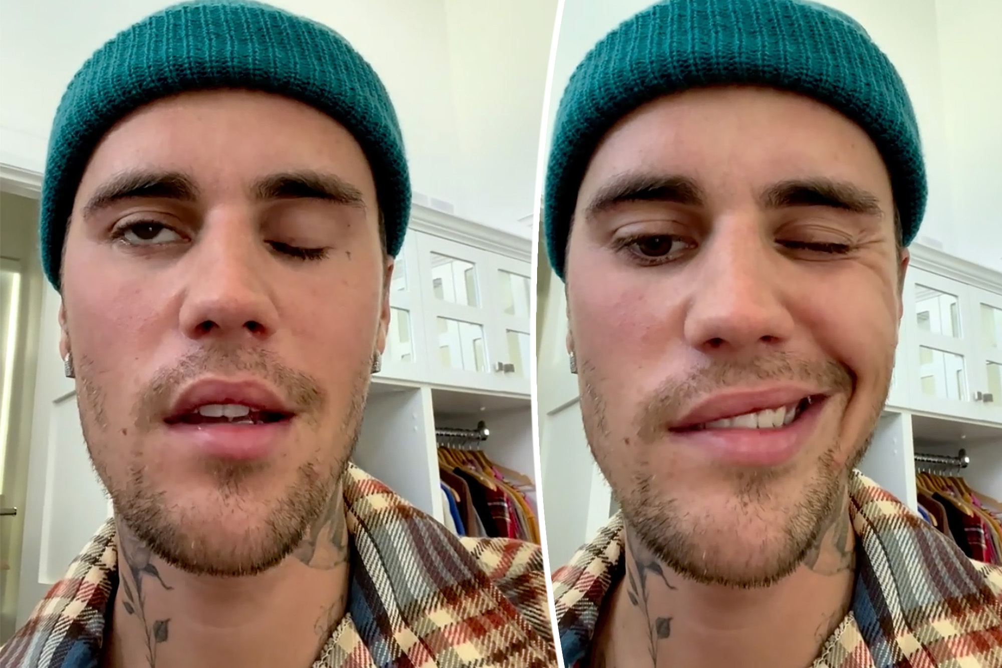 Justin Bieber's face paralyzed after being diagnosed with rare diso...