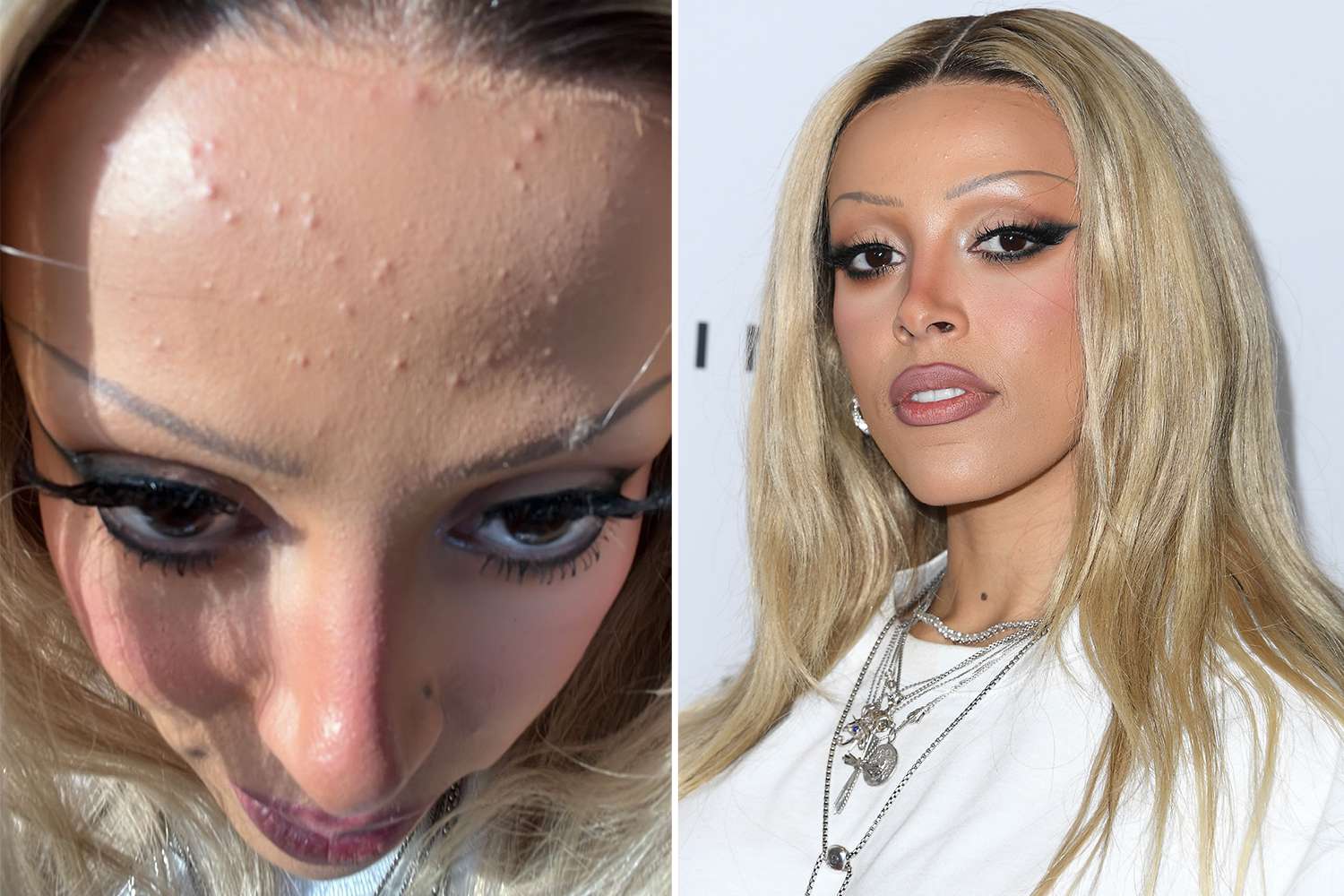 Doja Cat Reveals Forehead Acne in CloseUp Instagram Photo