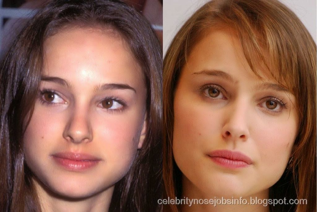 Natalie Portman Nose Job is the latest news from the popular Hollywood