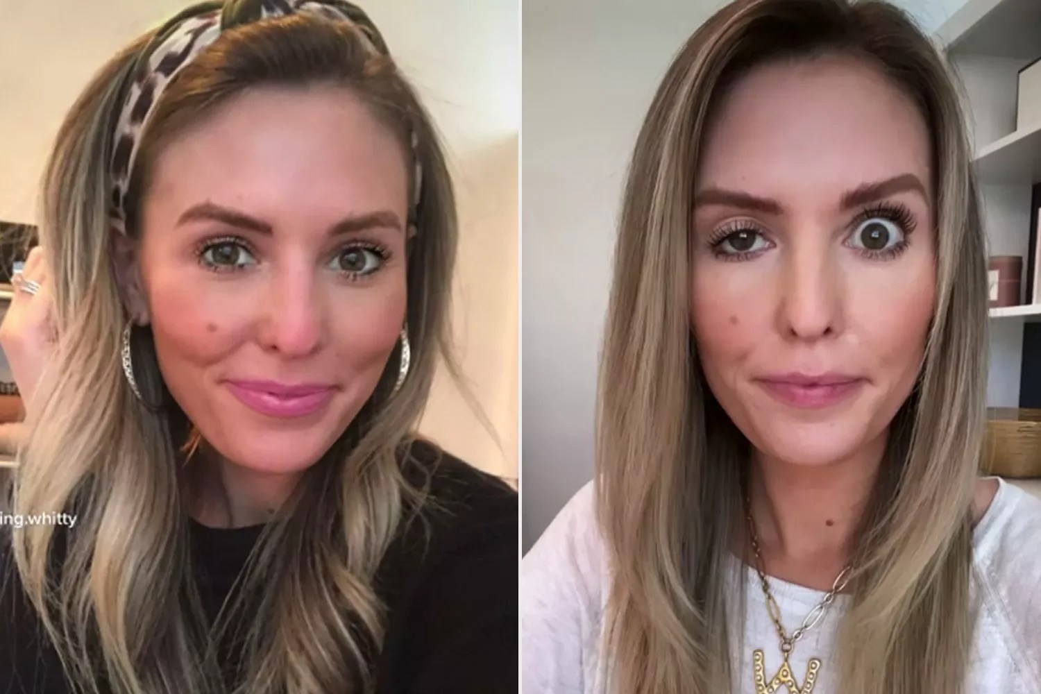 Botox Influencer compartilha sua experiência trágica com o