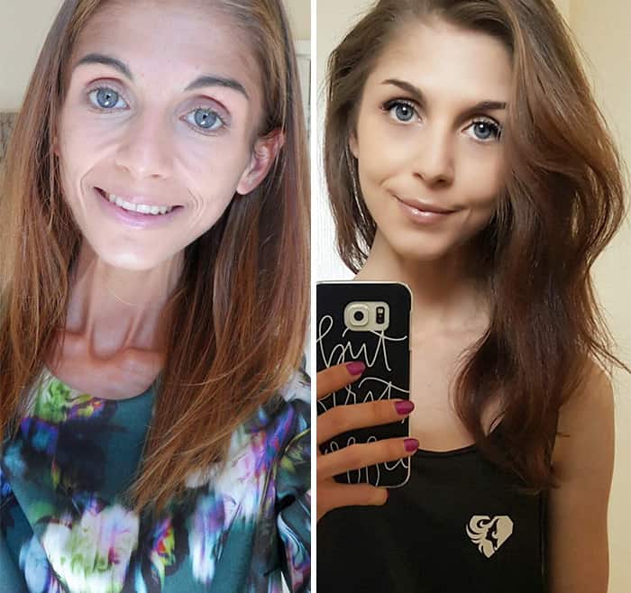 45 ‘Before & After’ Photos Of People Who Beat Anorexia True Activist