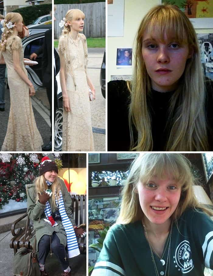 45 ‘Before & After’ Photos Of People Who Beat Anorexia True Activist