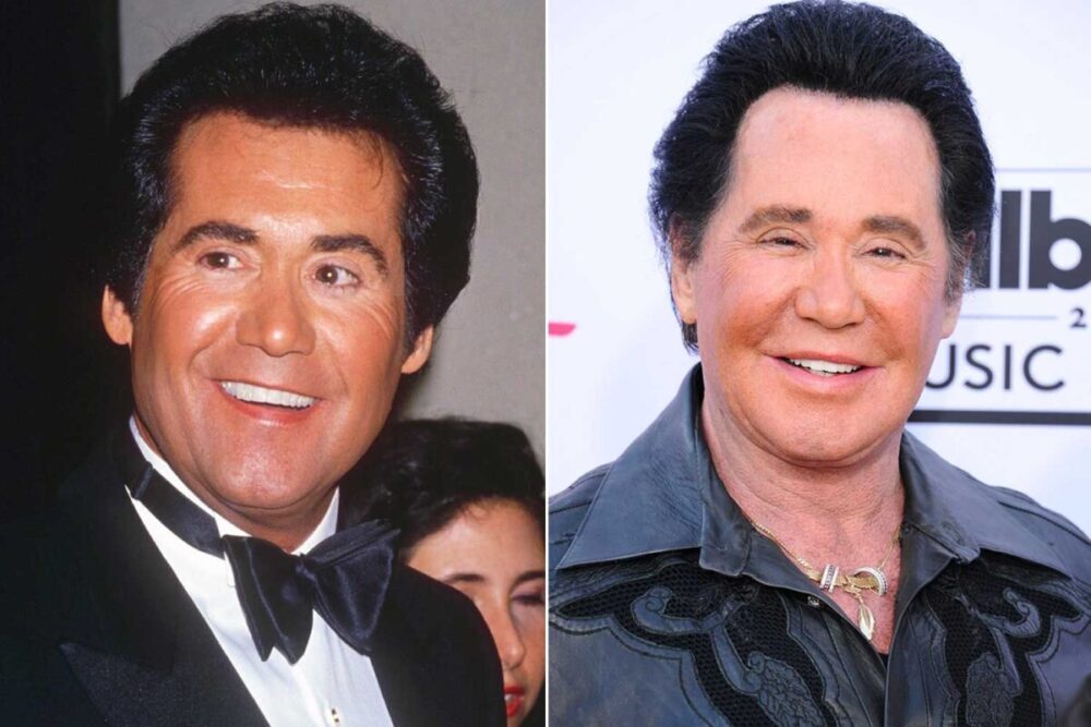 Wayne Newton Plastic Surgery With Before And After Photos