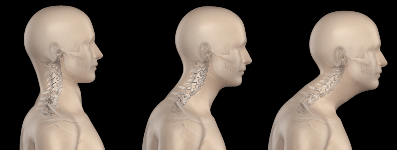 Do You Have Forward Head Posture? Spineology Chiropractic