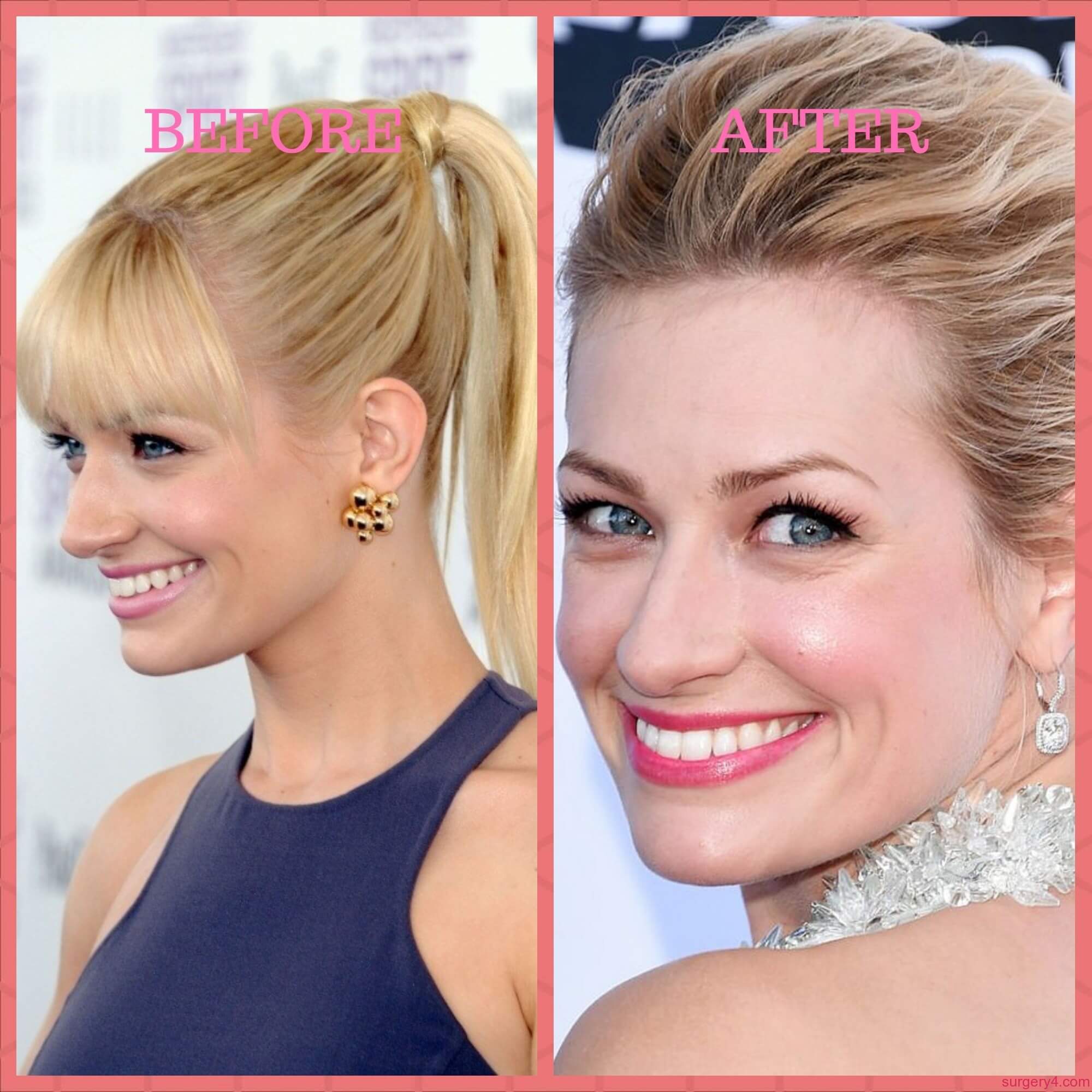 Beth Behrs Plastic Surgery Photos [Before & After] ⋆ Surgery4