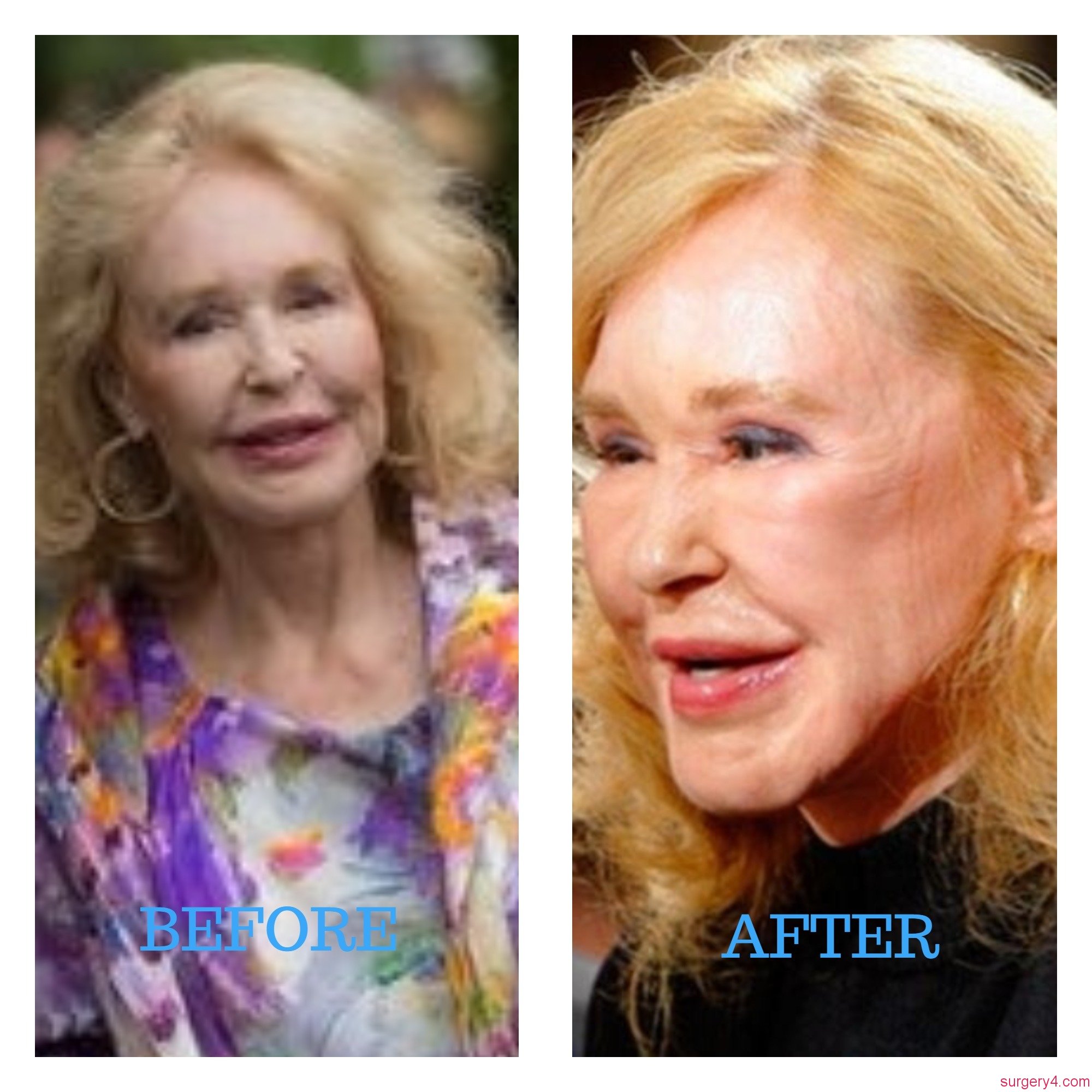 Joan Kennedy Today, Joan Kennedy Plastic Surgery Before and After Plastic, Kennedy