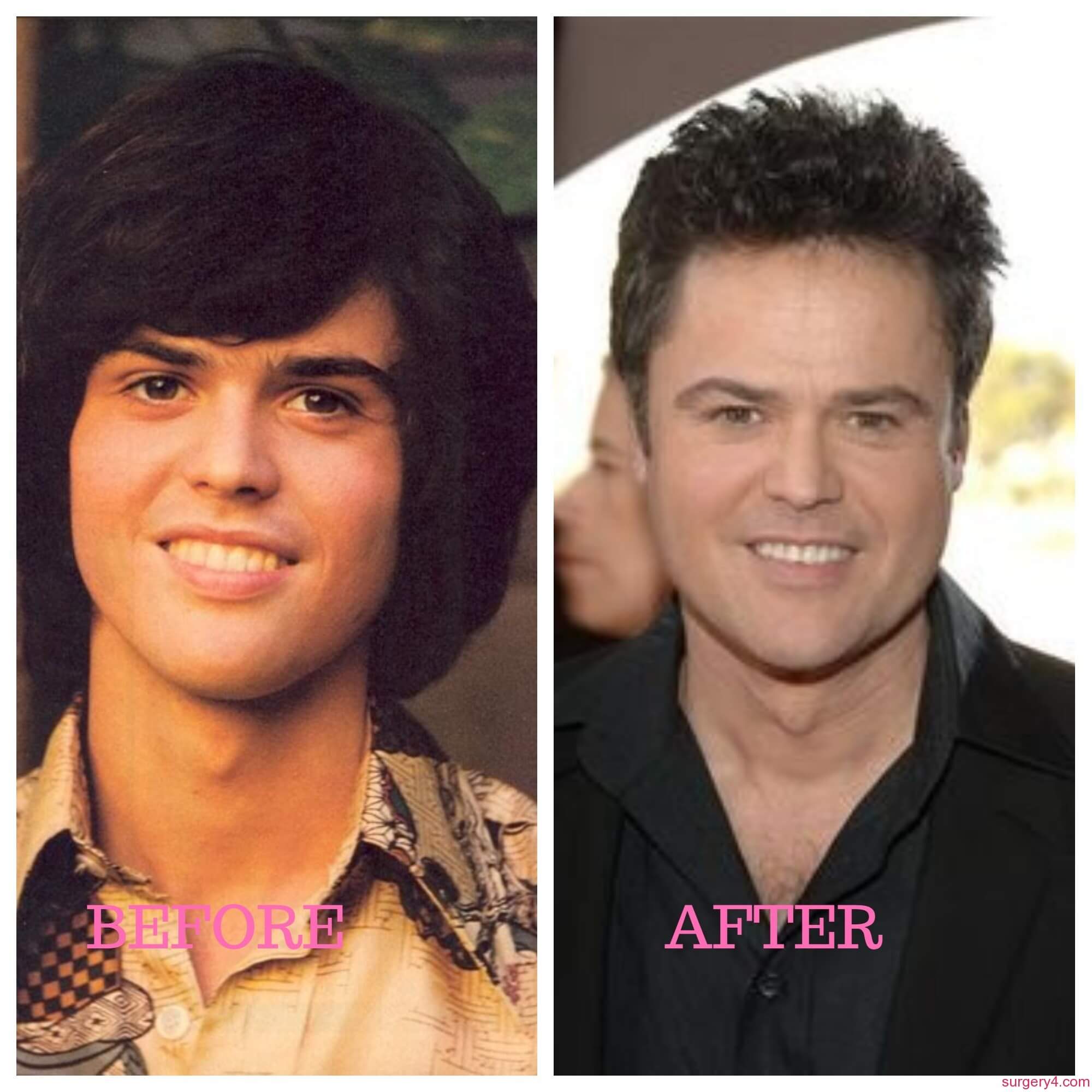 Donny Osmond Plastic Surgery Photos [Before & After] ⋆ Surgery4