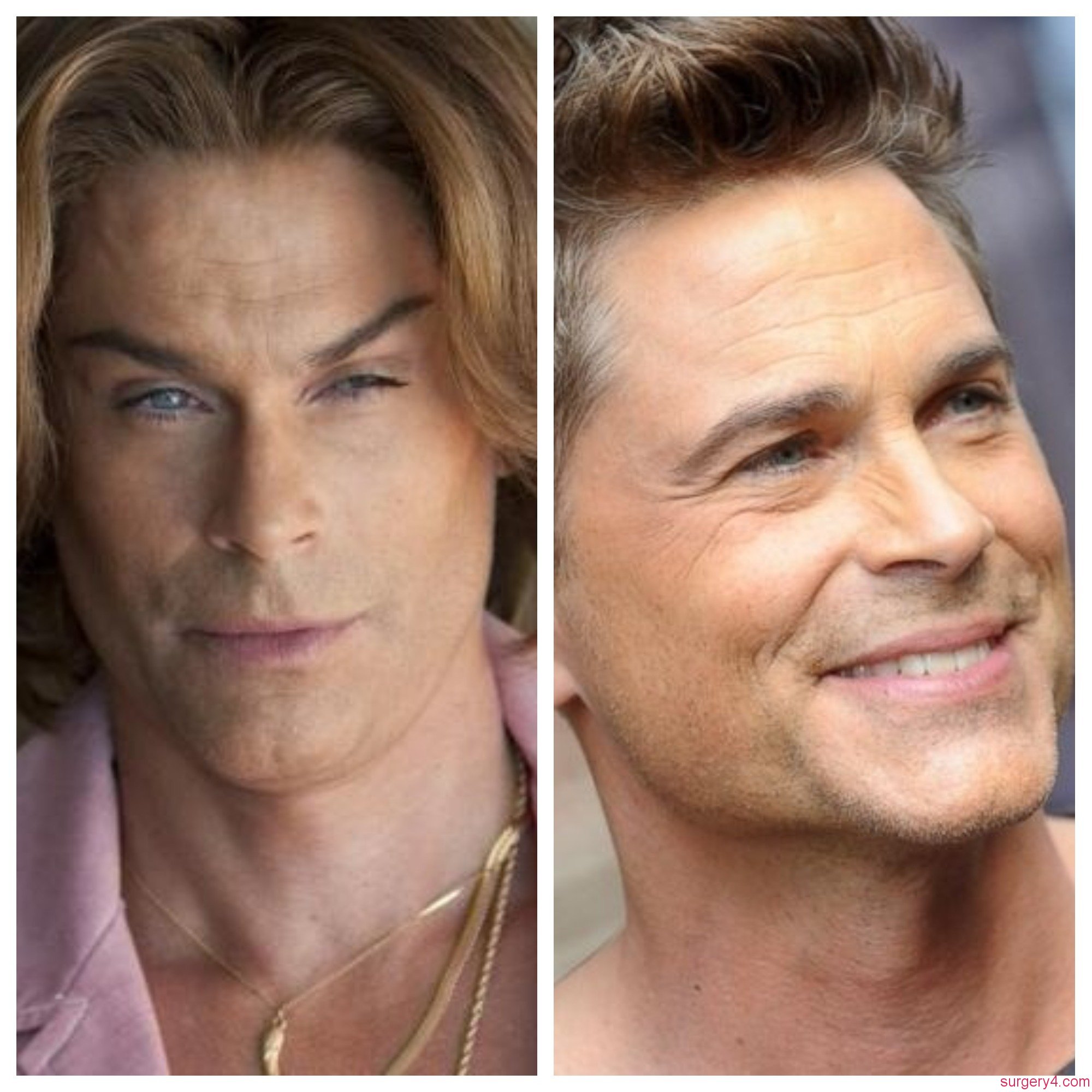 Rob Lowe Plastic Surgery Photos [Before & After] Surgery4