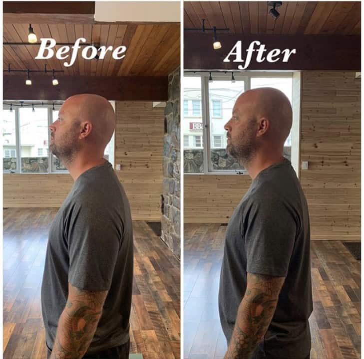 Forward Head Posture A Nontraditional Approach The Movement Paradigm