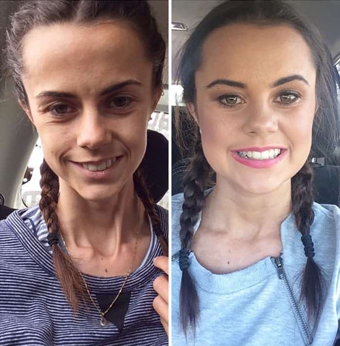 45 ‘Before & After’ Photos Of People Who Beat Anorexia True Activist