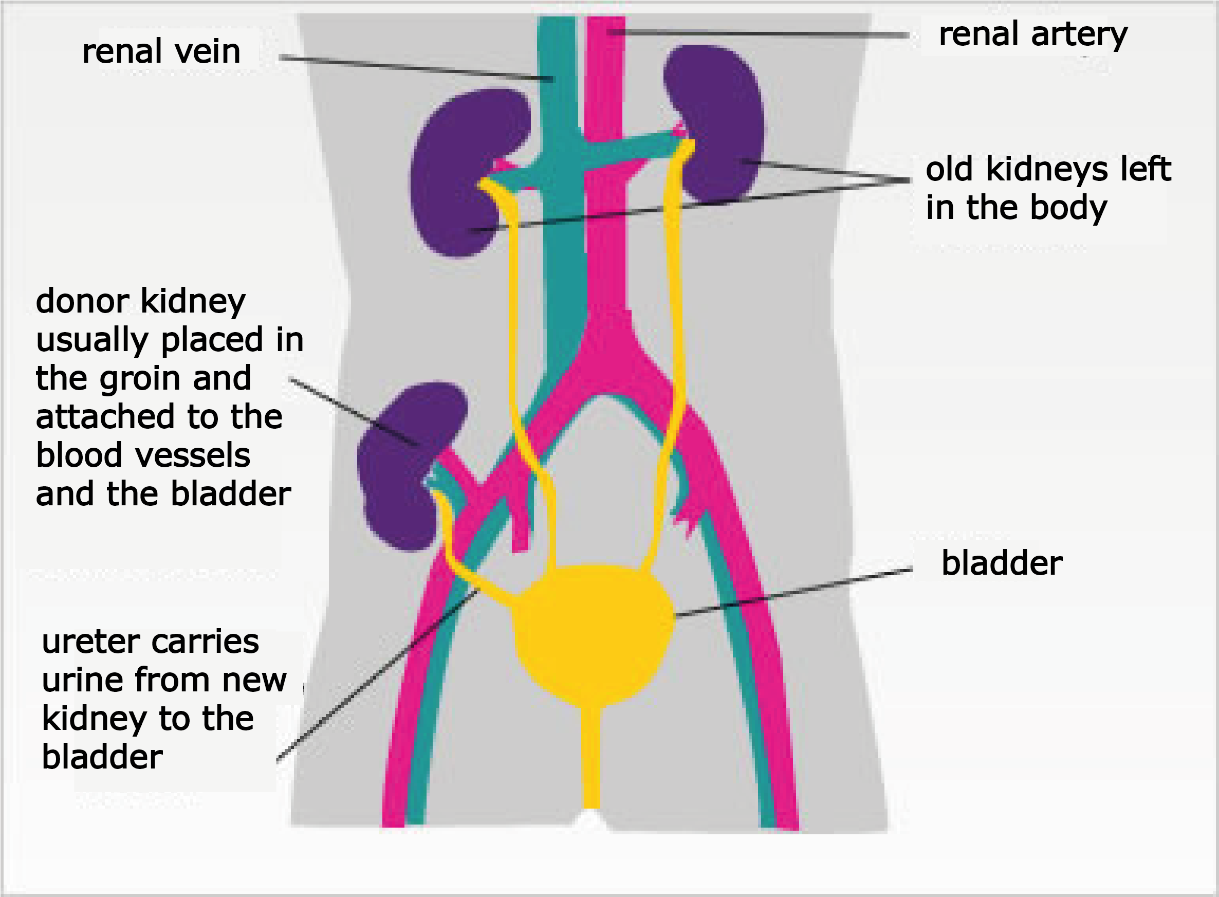 Kidney transplants