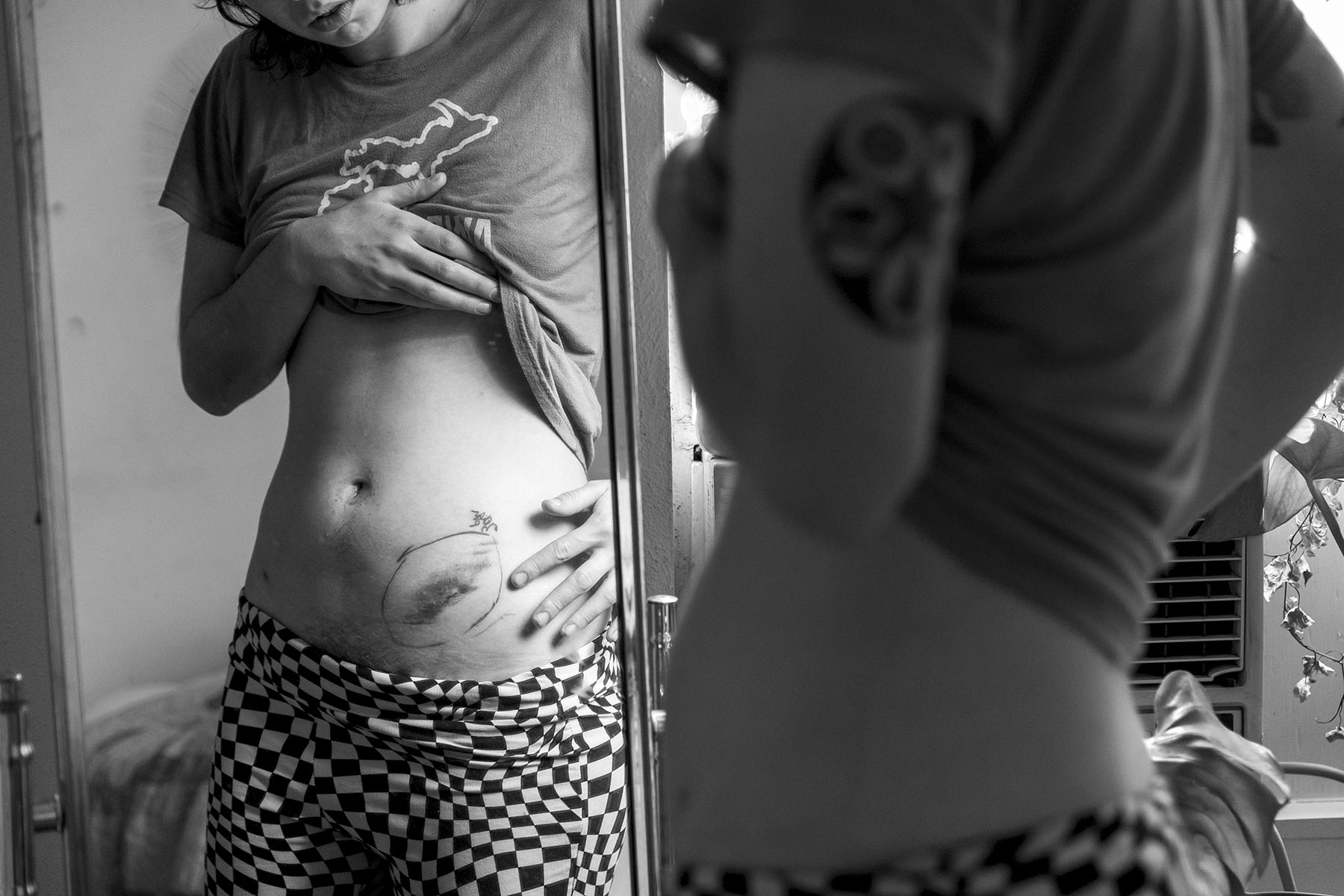 Gingerly, Josie Norris checks out bruising and swelling around one of their incision marks from their fallopian tube excision the day before in their bedroom mirror at home on Nov. 23, 2022, in San Antonio, Texas. “The sudden and alarmingly large swelling, as circled in marker, around one of my incisions kept me in the hospital until late as caring health care professionals made sure I was ok and safe to go home. Being alone in the hospital for around five hours really sucked and was so happy to get to sleep in my own bed.”