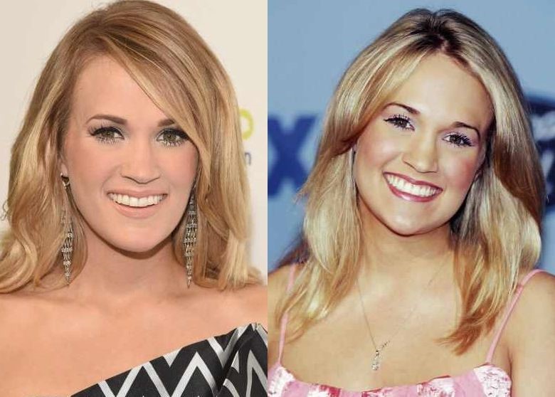 Carrie Underwood before and after plastic surgery Celebrity plastic