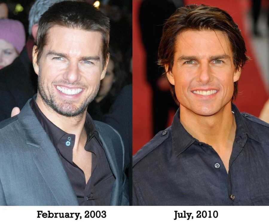 Tom Cruise is younger with help of plastic surgery