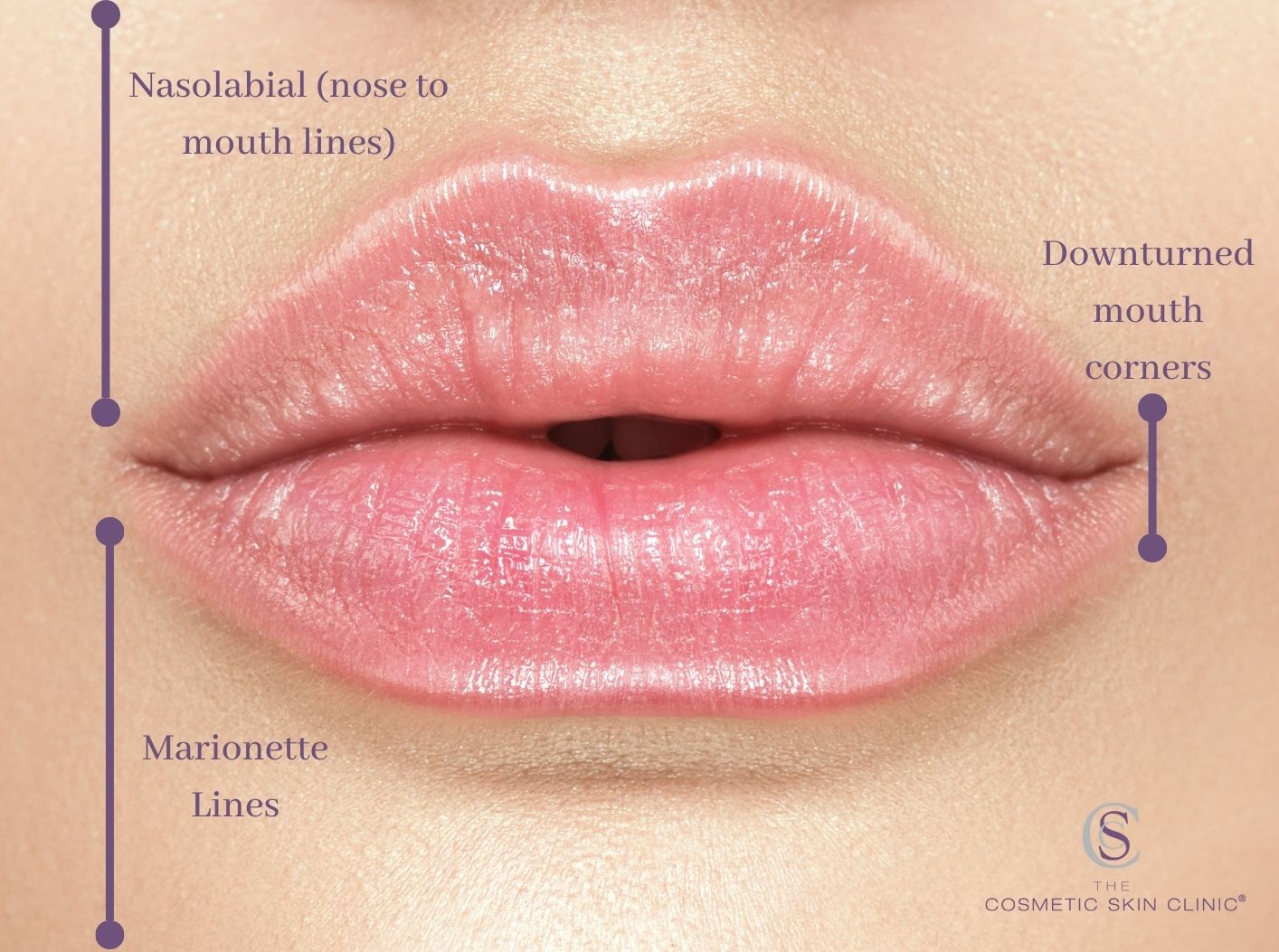 The Best Way to Fix Downturned Mouth Corners Filler, Botox for Downturned Mouth The Cosmetic