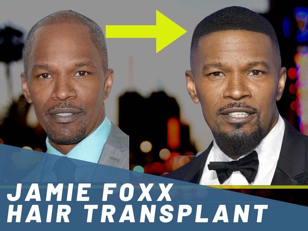 Jamie Foxx Hair Transplant Hair Loss & Technical Analysis