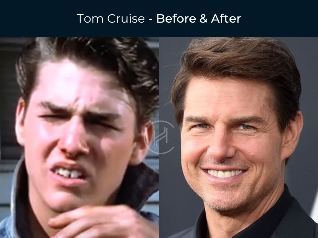 Celebrity Dental Implants and Veneers Before and After Luv68