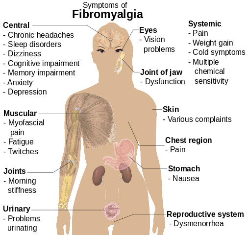 lupus vs. fibromyalgia